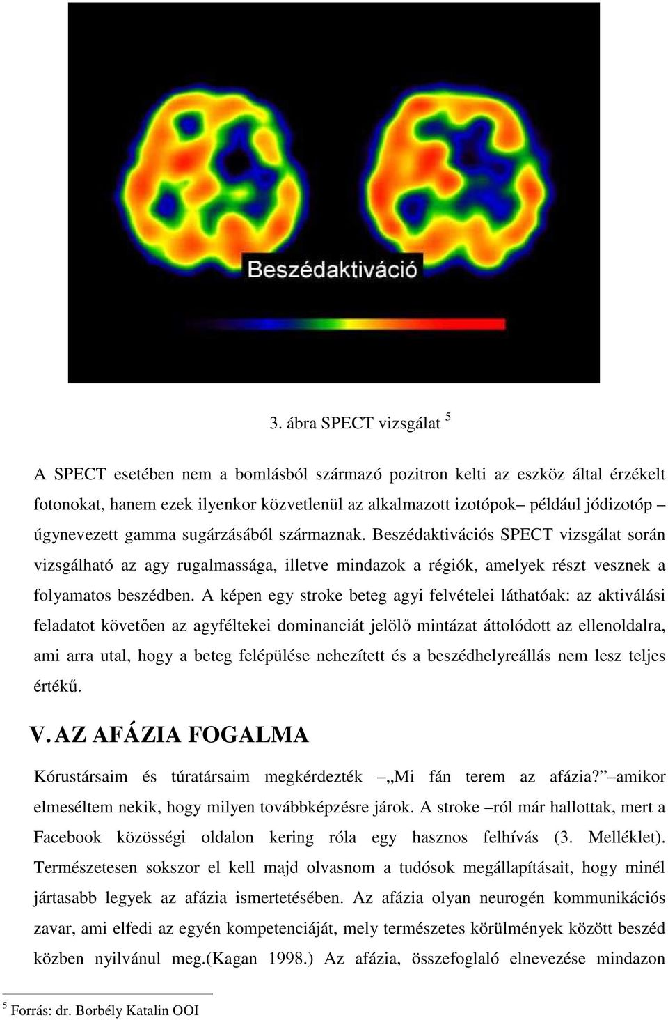 A képen egy stroke beteg agyi felvételei láthatóak: az aktiválási feladatot követıen az agyféltekei dominanciát jelölı mintázat áttolódott az ellenoldalra, ami arra utal, hogy a beteg felépülése