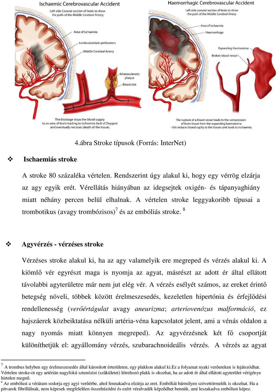 8 Agyvérzés - vérzéses stroke Vérzéses stroke alakul ki, ha az agy valamelyik ere megreped és vérzés alakul ki.