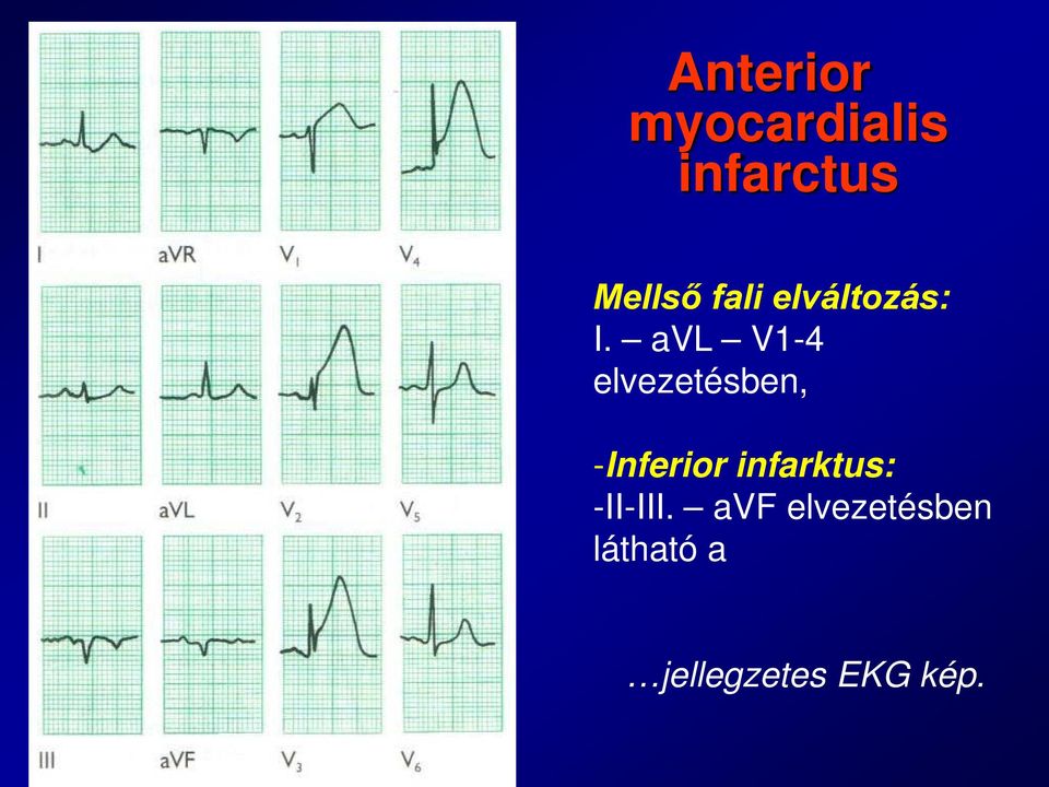 avl V1-4 elvezetésben, -Inferior