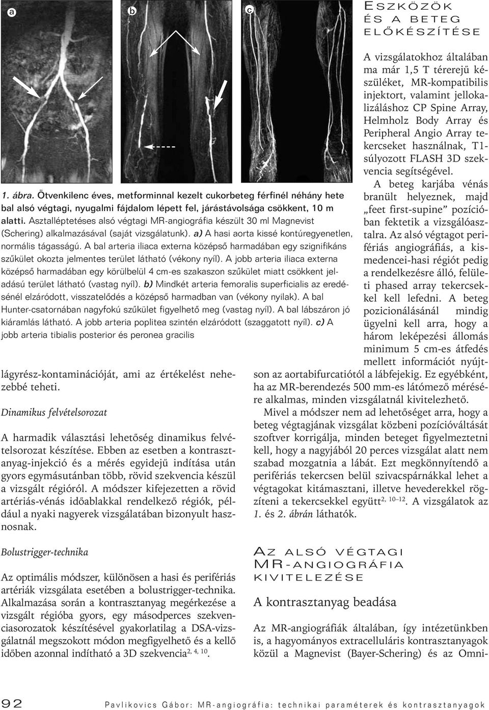 Asztalléptetéses alsó végtagi MR-angiográfia készült 30 ml Magnevist (Schering) alkalmazásával (saját vizsgálatunk). a) A hasi aorta kissé kontúregyenetlen, normális tágasságú.