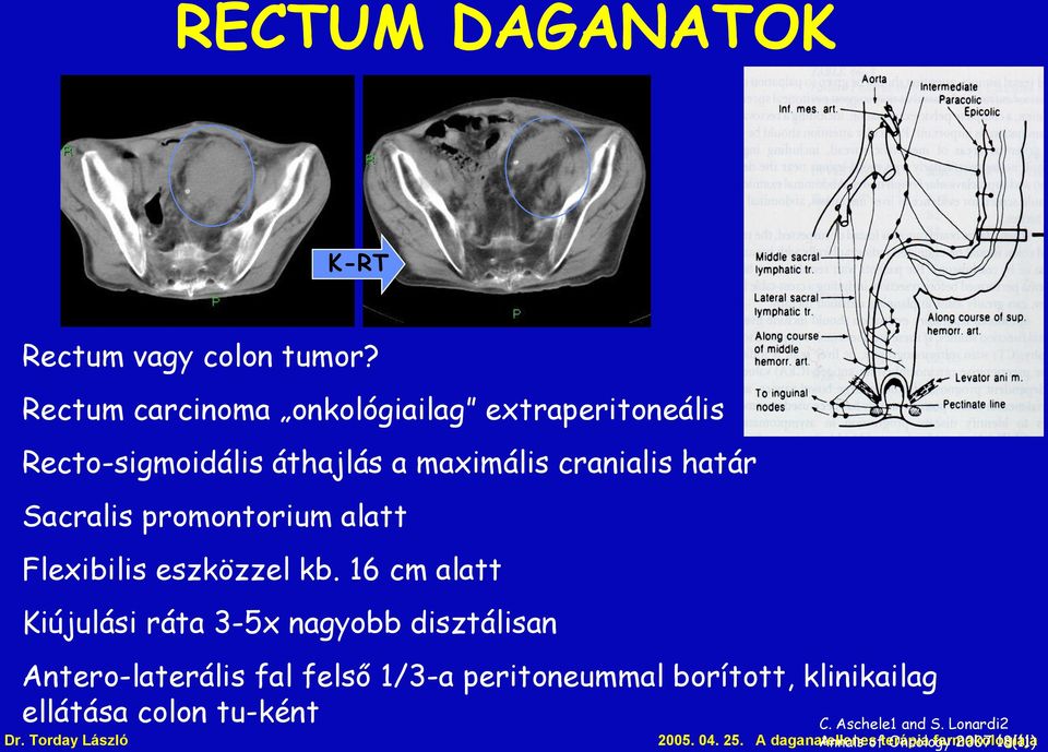 promontorium alatt Flexibilis eszközzel kb.