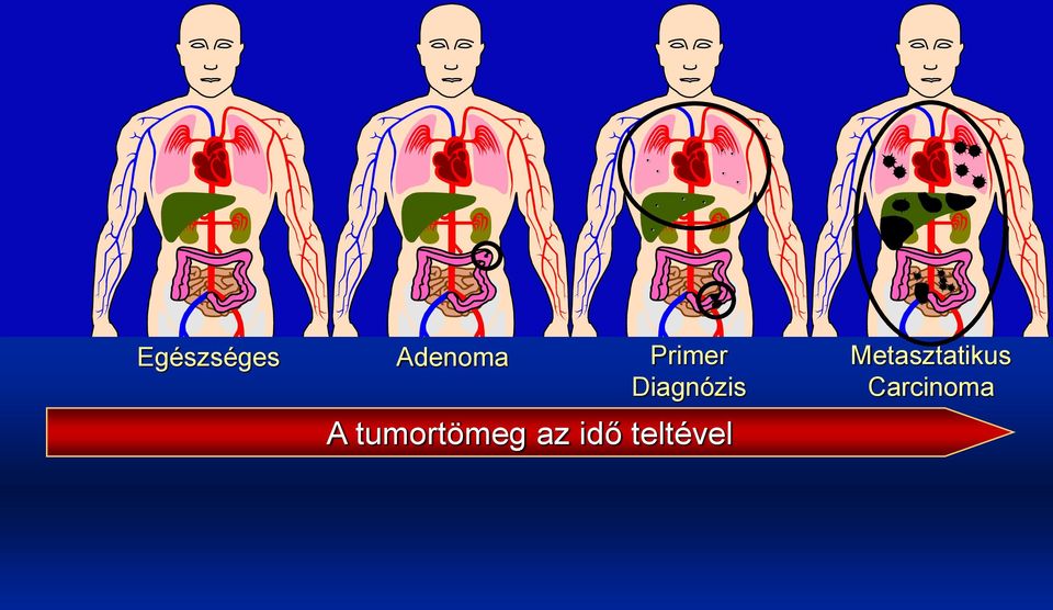 Metasztatikus Carcinoma Dr.