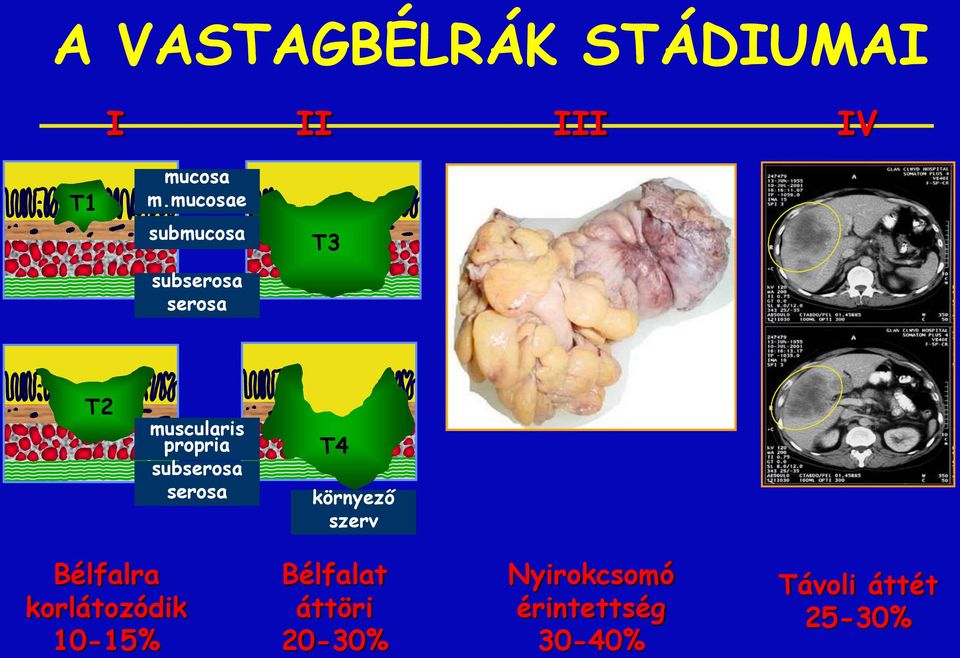 subserosa serosa T4 környező szerv N+ Bélfalra korlátozódik