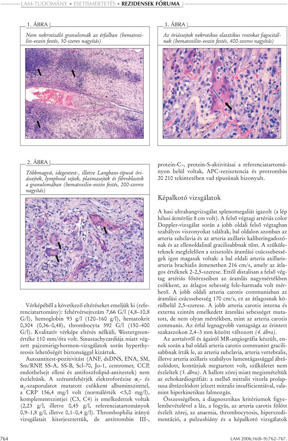 ÁBRA Többmagvú, idegentest-, illetve Langhans-típusú óriássejtek, lymphoid sejtek, plazmasejtek és fibroblastok a granulomában (hematoxilin-eozin festés, 200-szoros nagyítás) Vérképébôl a következô