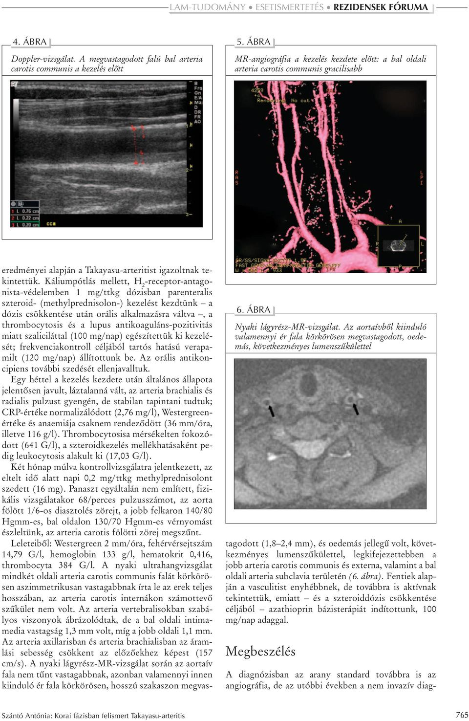 Az aortaívbôl kiinduló valamennyi ér fala körkörösen megvastagodott, oedemás, következményes lumenszûkülettel eredményei alapján a Takayasu-arteritist igazoltnak tekintettük.