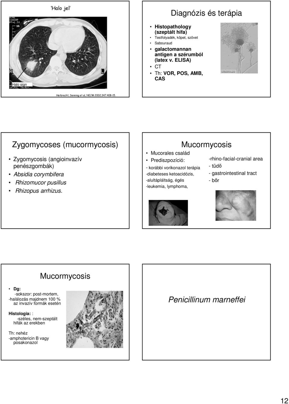 Zygomycoses (mucormycosis) Zygomycosis (angioinvazív penészgombák) Absidia corymbifera Rhizomucor pusillus Rhizopus arrhizus.