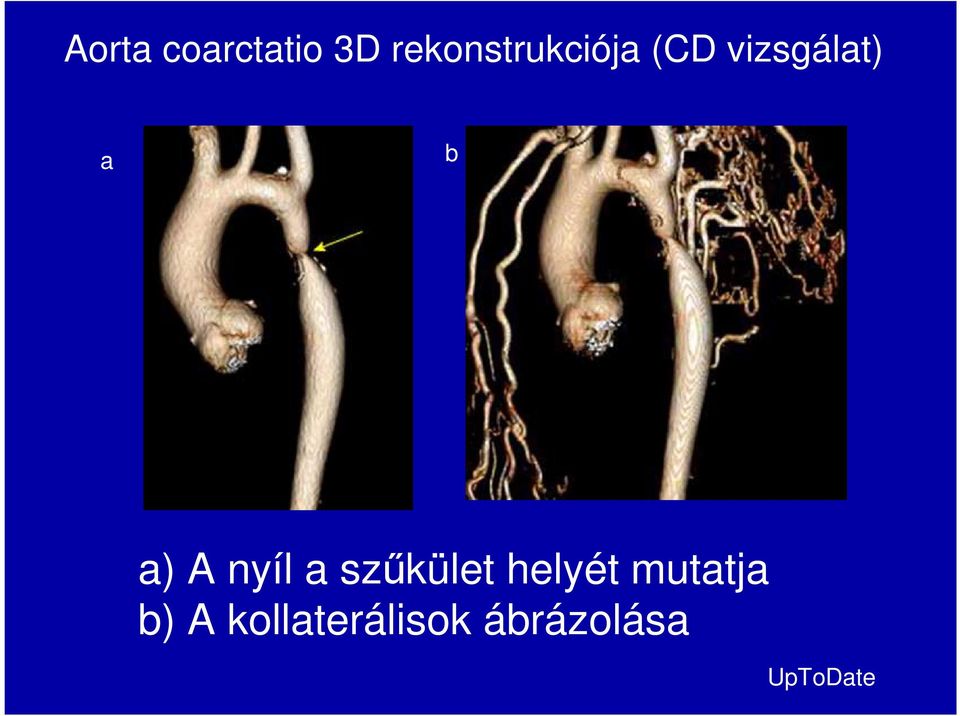 b a) A nyíl a szőkület helyét