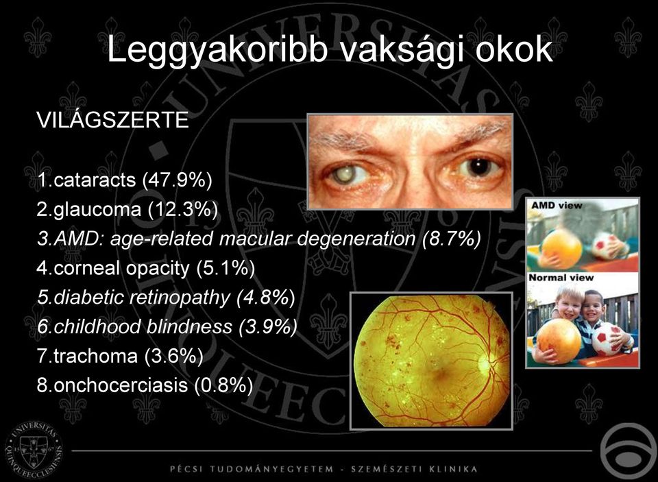 7%) 4.corneal opacity (5.1%) 5.diabetic retinopathy (4.8%) 6.