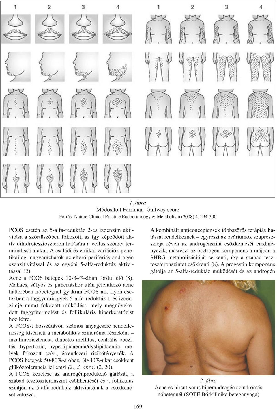 A családi és etnikai variációk genetikailag magyarázhatók az eltérô perifériás androgén szenzitivitással és az egyéni 5-alfa-reduktáz aktivitással (2). Acne a PCOS betegek 10-34%-ában fordul elô (8).