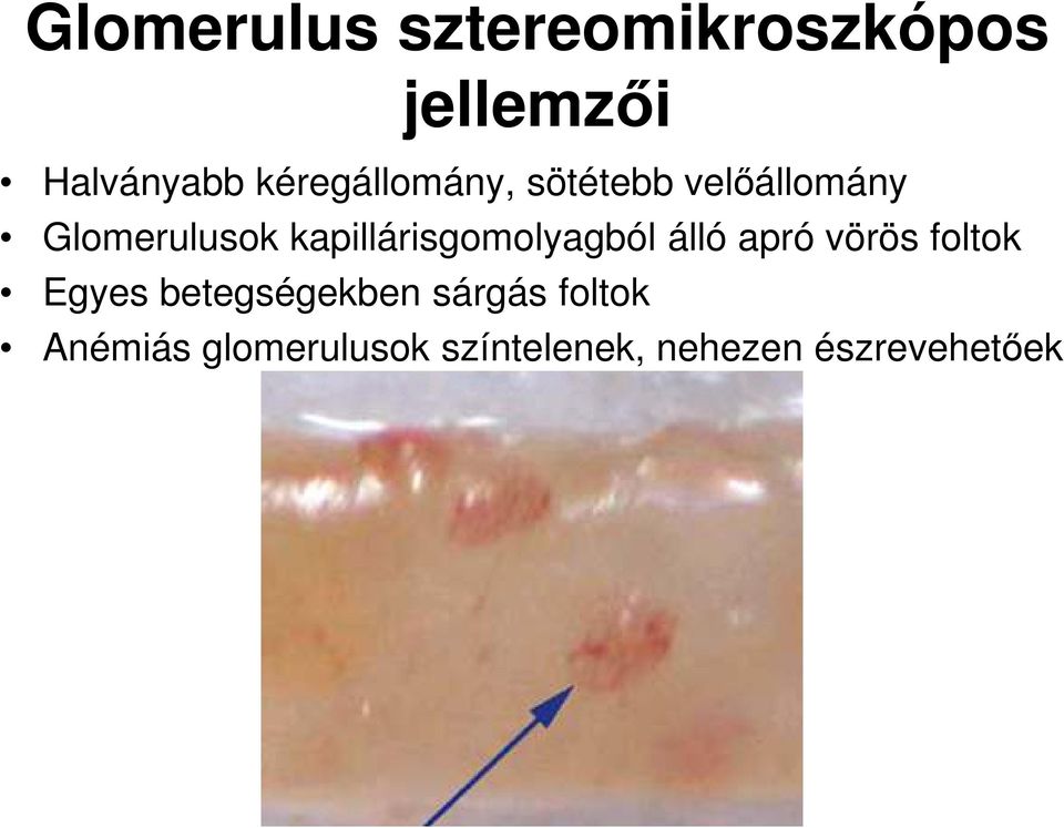 kapillárisgomolyagból álló apró vörös foltok Egyes