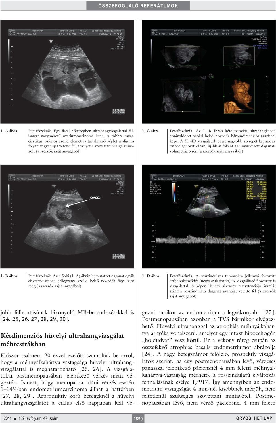 Az 1. B ábrán kétdimenziós ultrahangképen ábrázolódott szolid belső növedék háromdimenziós (surface) képe.