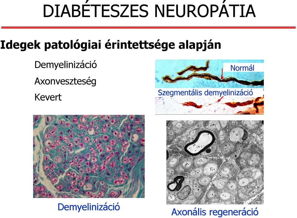 Axonveszteség Kevert Normál Szegmentális