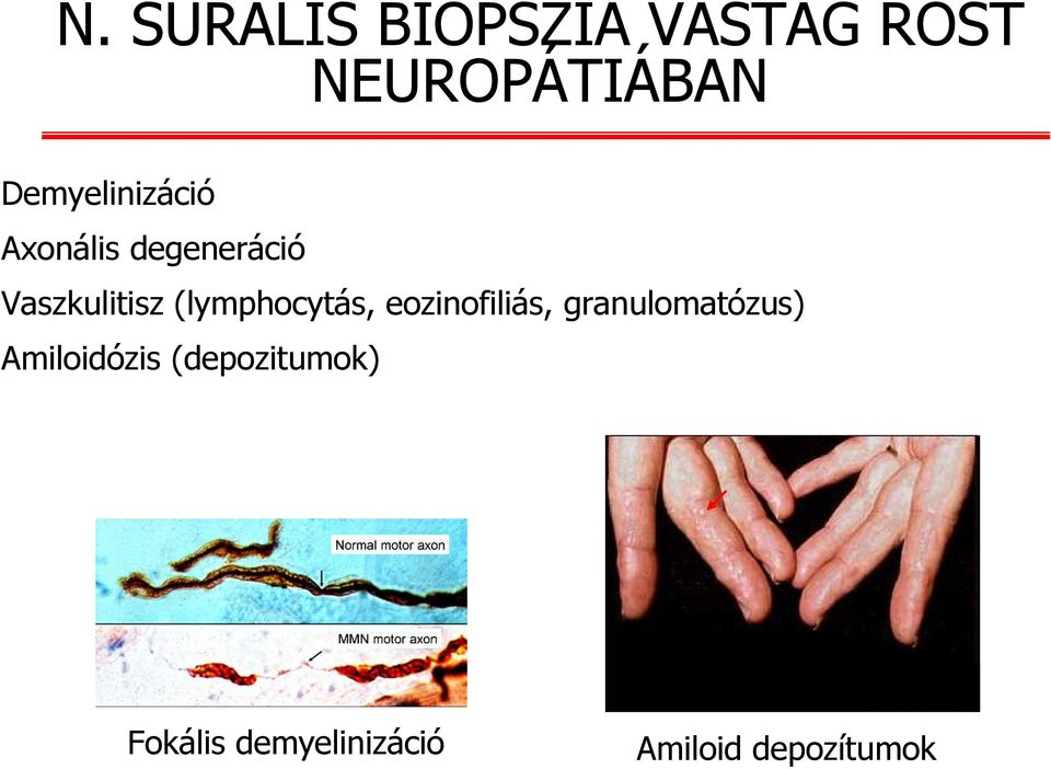 (lymphocytás, eozinofiliás, granulomatózus)