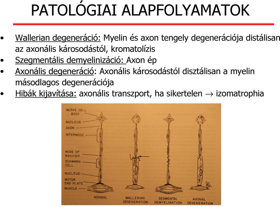 demyelinizáció: Axon ép Axonális degeneráció: Axonális károsodástól disztálisan a