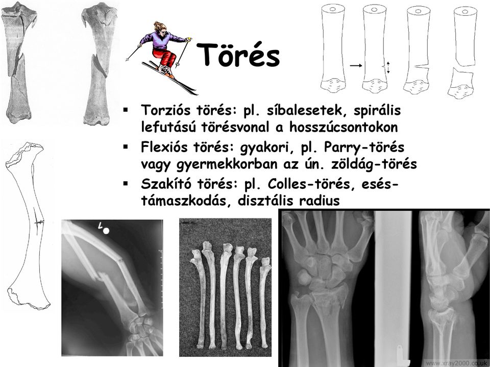 hosszúcsontokon Flexiós törés: gyakori, pl.