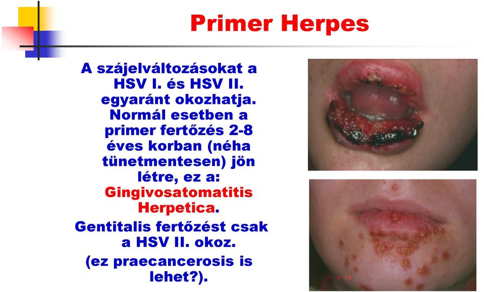 tünetmentesen) jön létre, ez a: Gingivosatomatitis Herpetica.