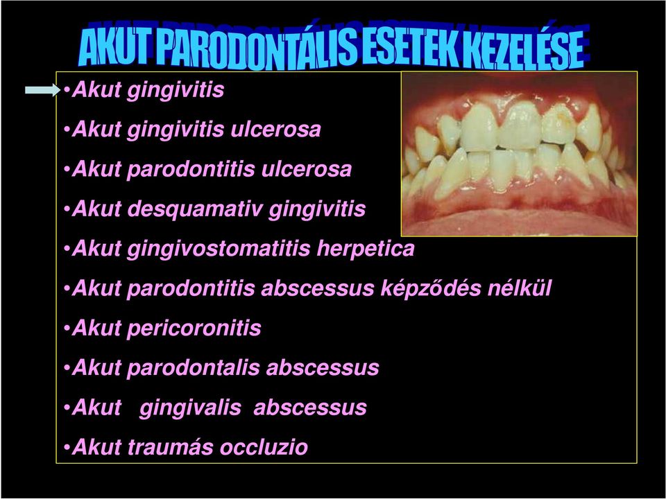 parodontitis ulcerosa Akut desquamativ gingivitis Akut gingivostomatitis