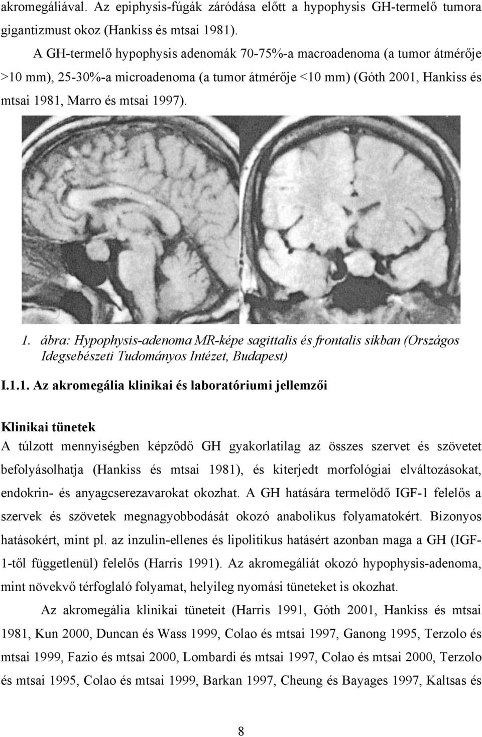 81, Marro és mtsai 1997). 1. ábra: Hypophysis-adenoma MR-képe sagittalis és frontalis síkban (Országos Idegsebészeti Tudományos Intézet, Budapest) I.1.1. Az akromegália klinikai és laboratóriumi