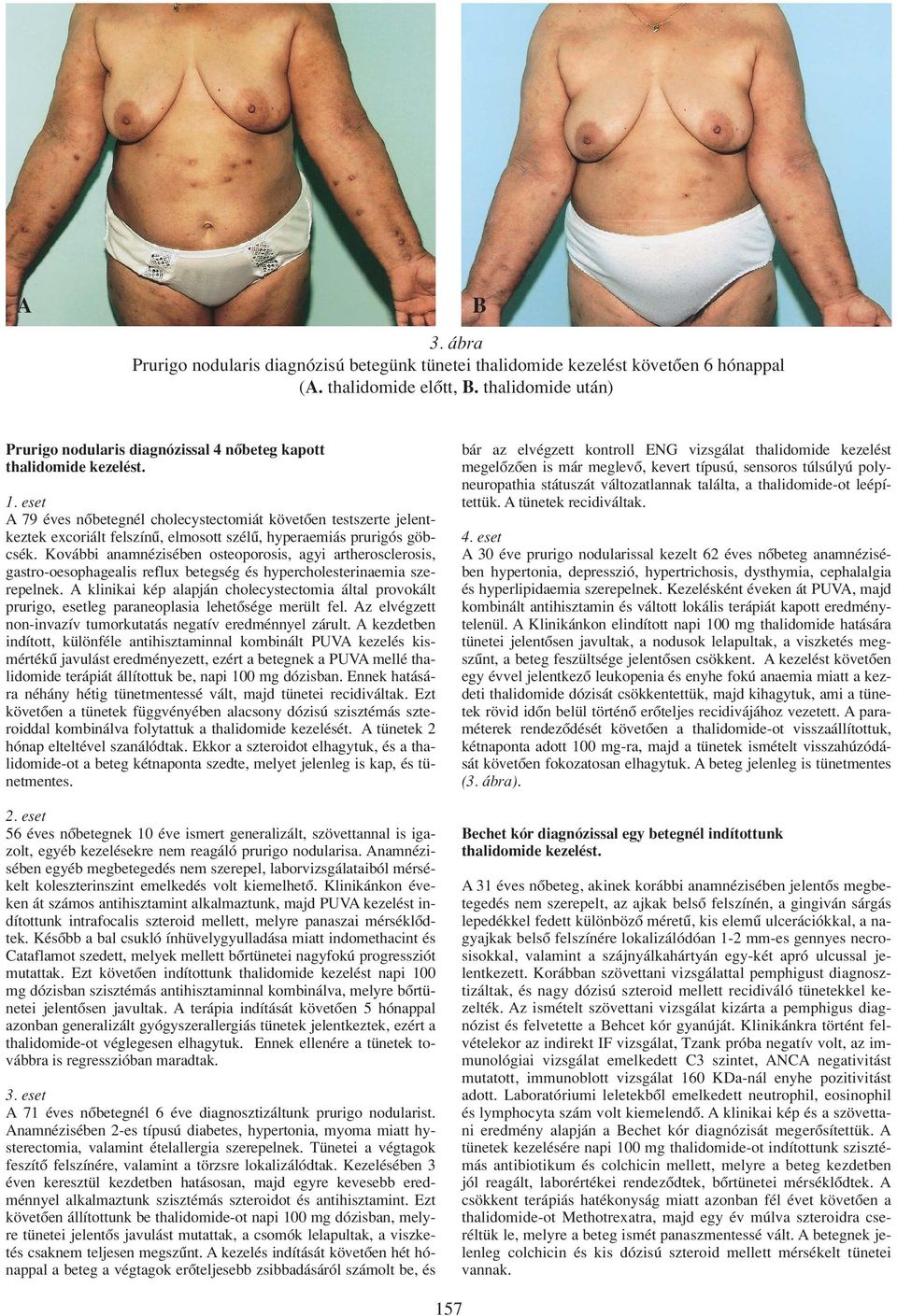 Kovábbi anamnézisében osteoporosis, agyi artherosclerosis, gastro-oesophagealis reflux betegség és hypercholesterinaemia szerepelnek.