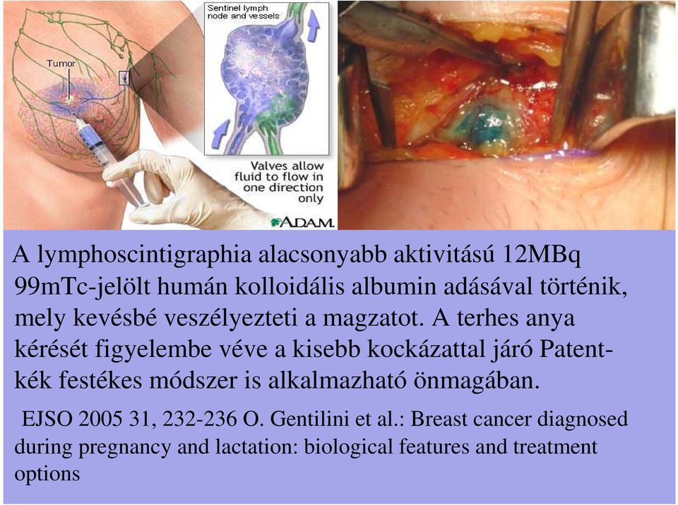 A terhes anya kérését figyelembe véve a kisebb kockázattal járó Patentkék festékes módszer is