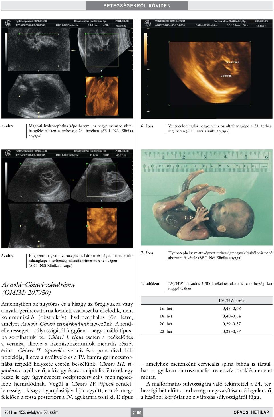 ábra Hydrocephalus miatt végzett terhességmegszakításból származó abortum felvétele Arnold Chiari-szindróma (OMIM: 207950) Amennyiben az agytörzs és a kisagy az öreglyukba vagy a nyaki gerinccsatorna