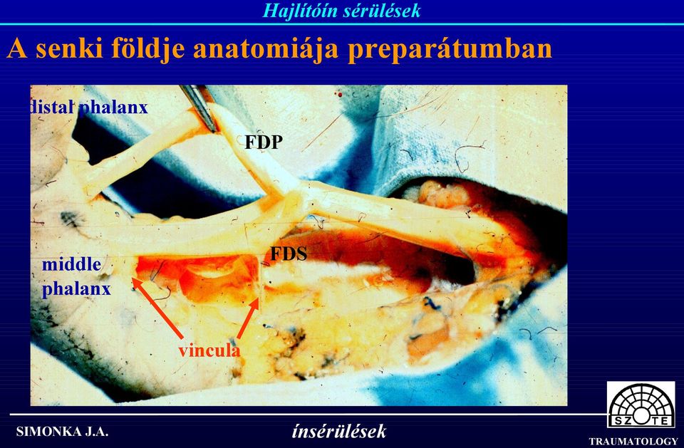 phalanx FDP FDS middle