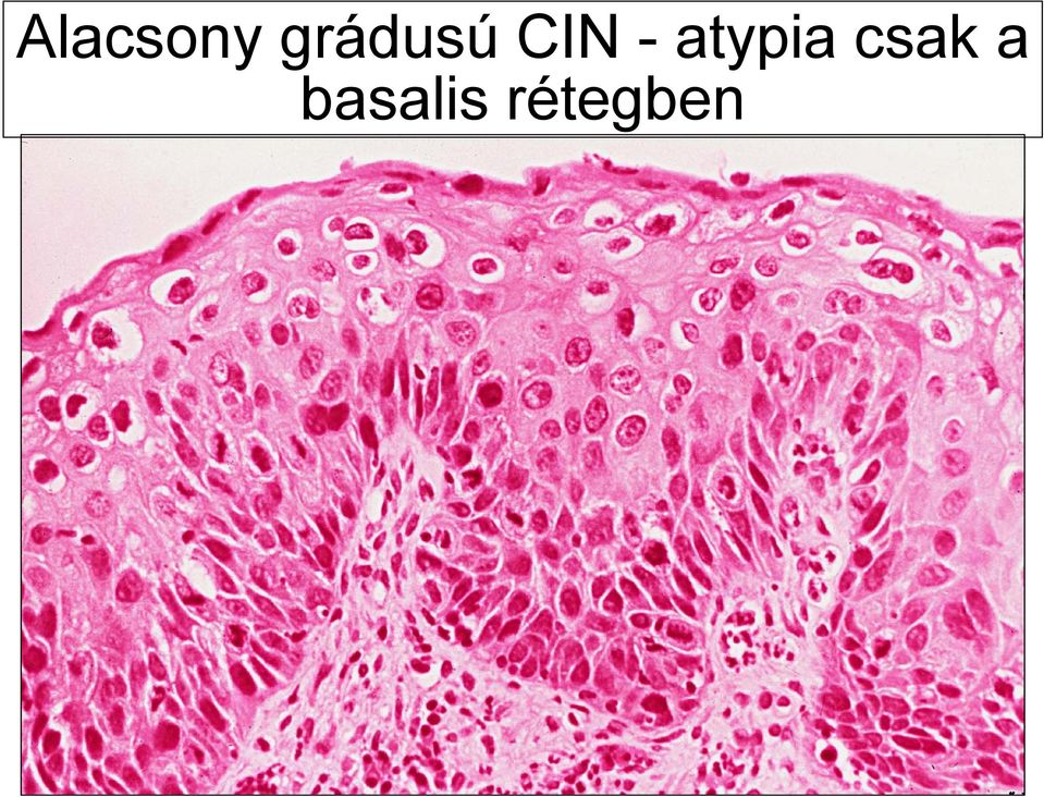 atypia csak a