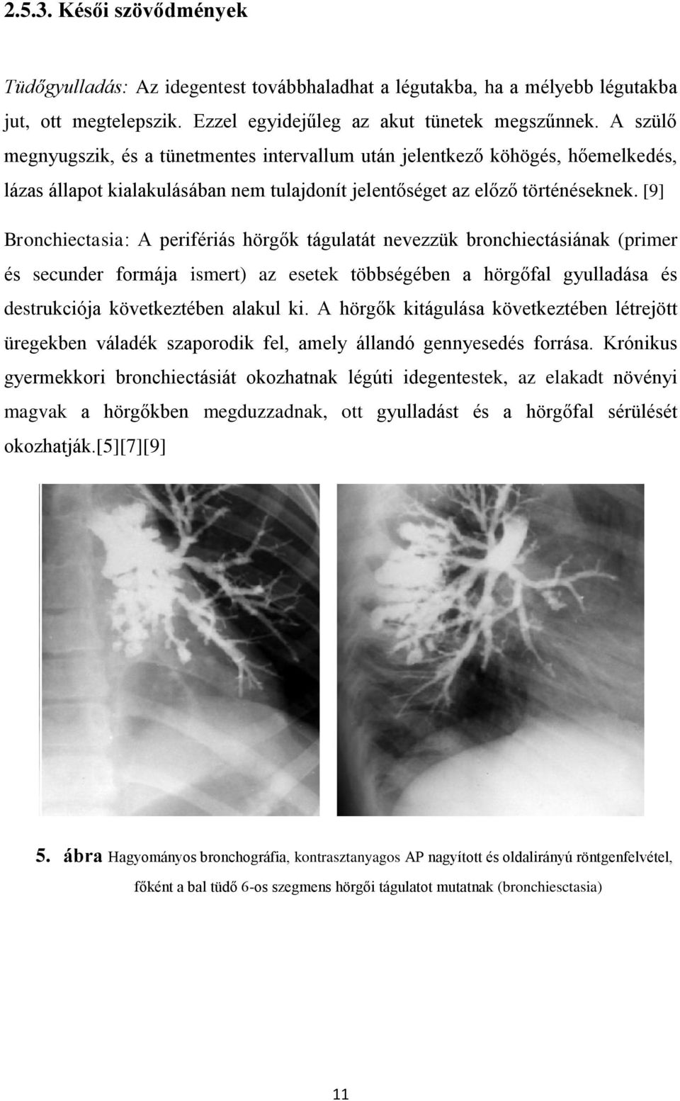 [9] Bronchiectasia: A perifériás hörgők tágulatát nevezzük bronchiectásiának (primer és secunder formája ismert) az esetek többségében a hörgőfal gyulladása és destrukciója következtében alakul ki.