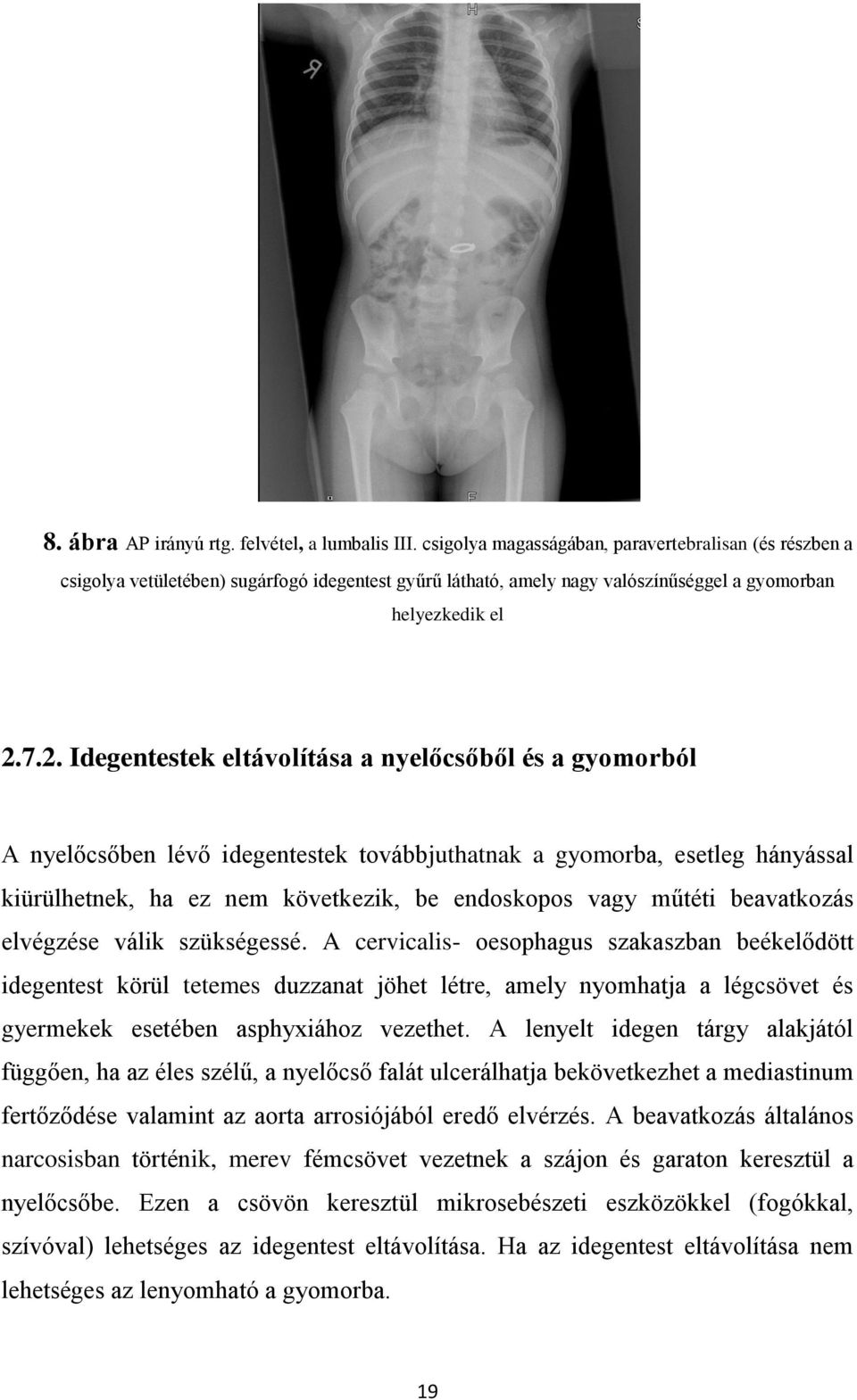 7.2. Idegentestek eltávolítása a nyelőcsőből és a gyomorból A nyelőcsőben lévő idegentestek továbbjuthatnak a gyomorba, esetleg hányással kiürülhetnek, ha ez nem következik, be endoskopos vagy műtéti