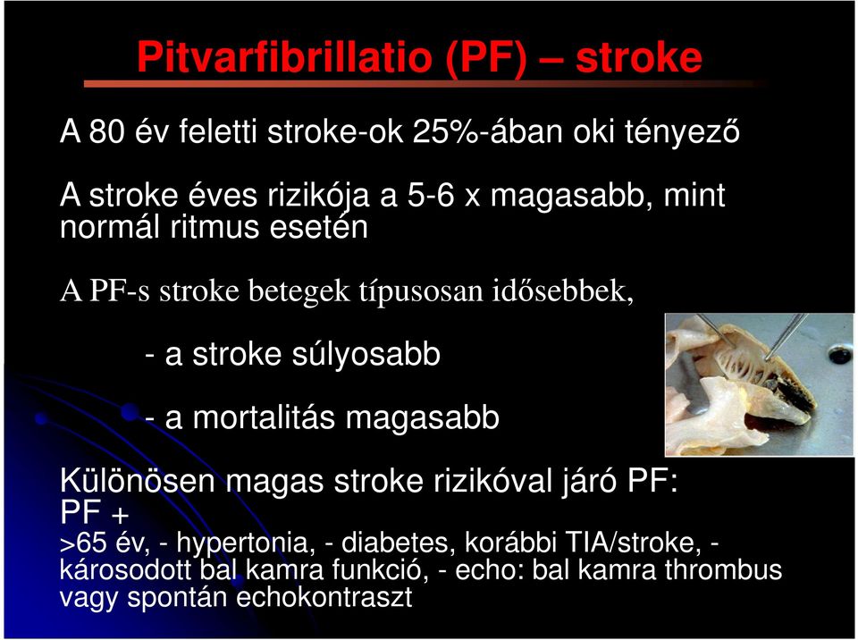 súlyosabb - a mortalitás magasabb Különösen magas stroke rizikóval járó PF: PF + >65 év, - hypertonia, -