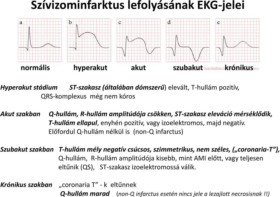 Előfordul Q-hullám nélkül is (non-q infarctus) Szubakut szakban T-hullám mély negatív csúcsos, szimmetrikus, nem széles, ( coronaria-t ), Q-hullám, R-hullám amplitúdója kisebb,