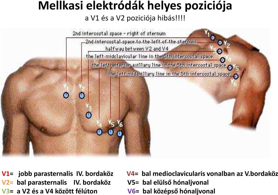 bordaköz V4= bal medioclavicularis vonalban az V.