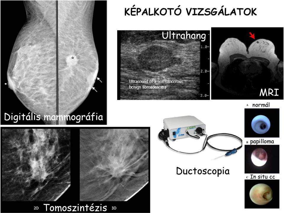 mammográfia MRI normál