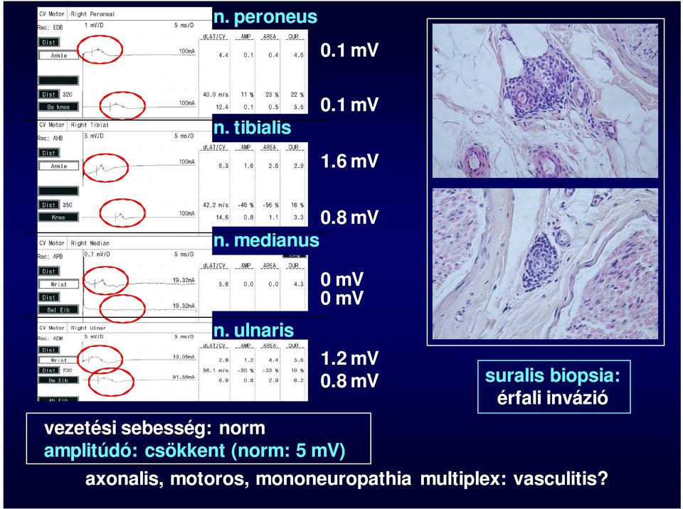 ulnaris 0 mv 0 mv vezetési sebesség: norm amplitúdó: csökkent