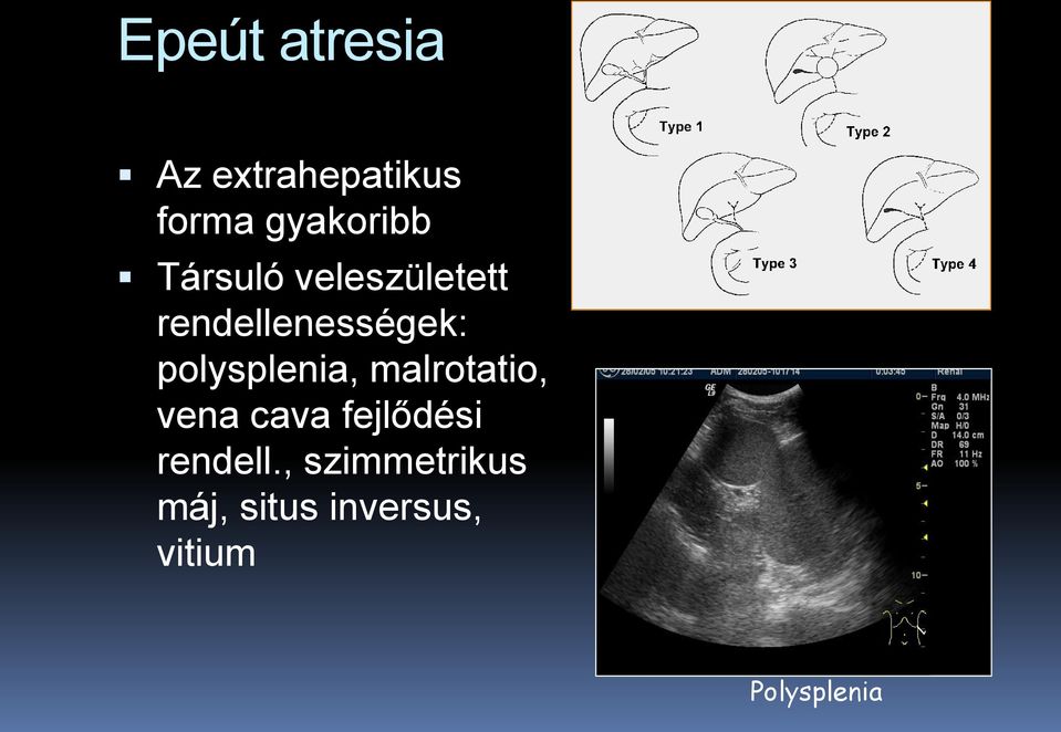 polysplenia, malrotatio, vena cava fejlődési