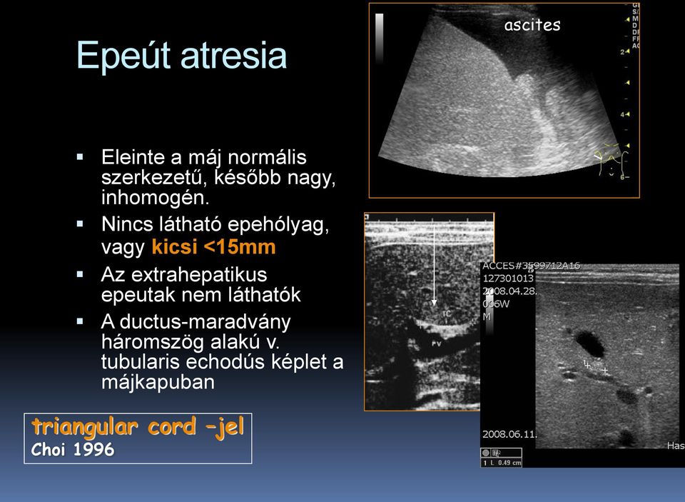 Nincs látható epehólyag, vagy kicsi <15mm Az extrahepatikus