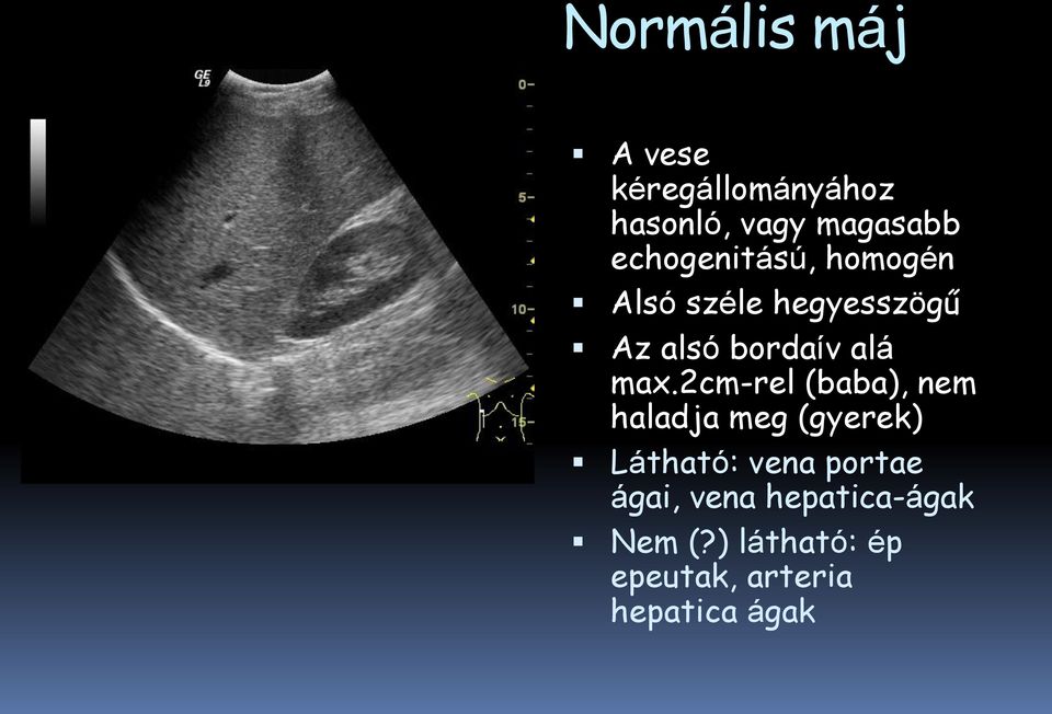 max.2cm-rel (baba), nem haladja meg (gyerek) Látható: vena portae