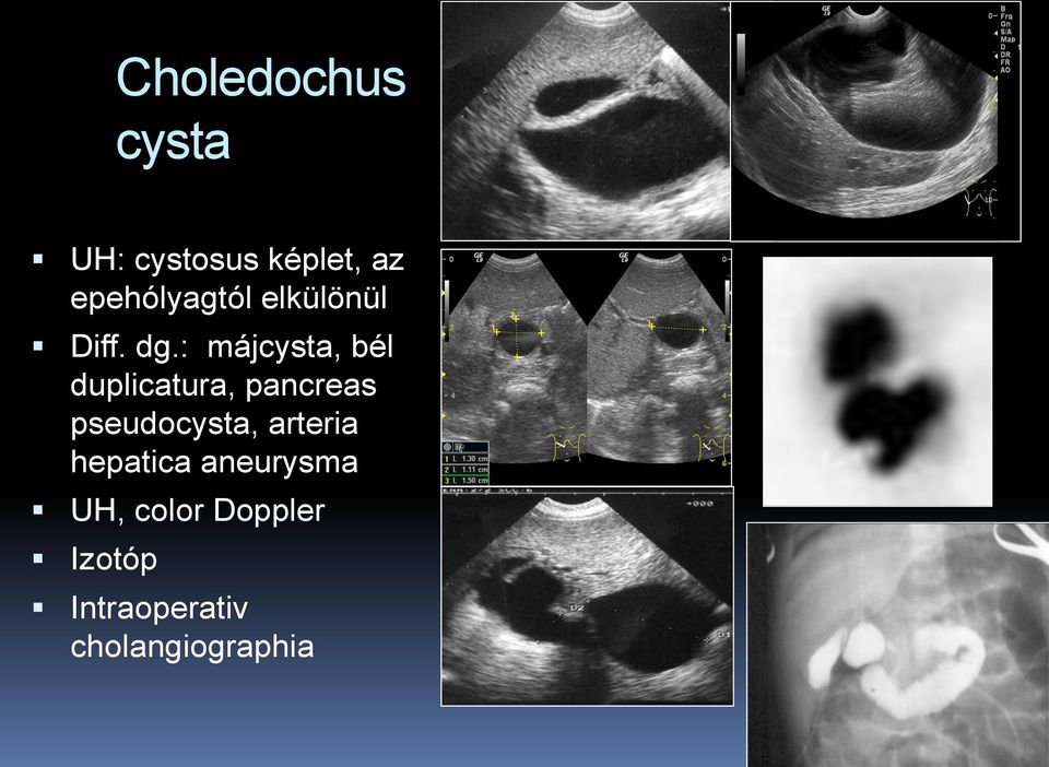 : májcysta, bél duplicatura, pancreas pseudocysta,