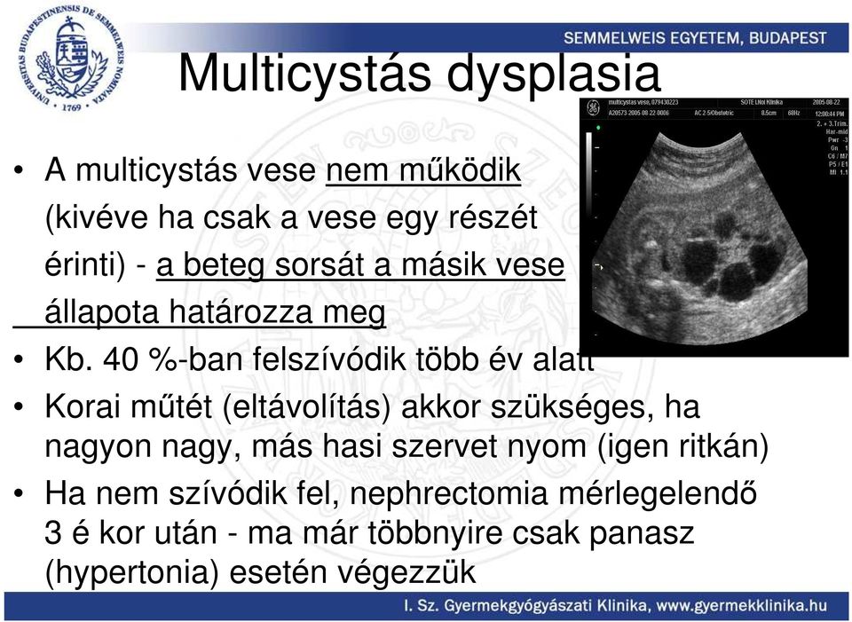 40 %-ban felszívódik több év alatt Korai mőtét (eltávolítás) akkor szükséges, ha nagyon nagy, más