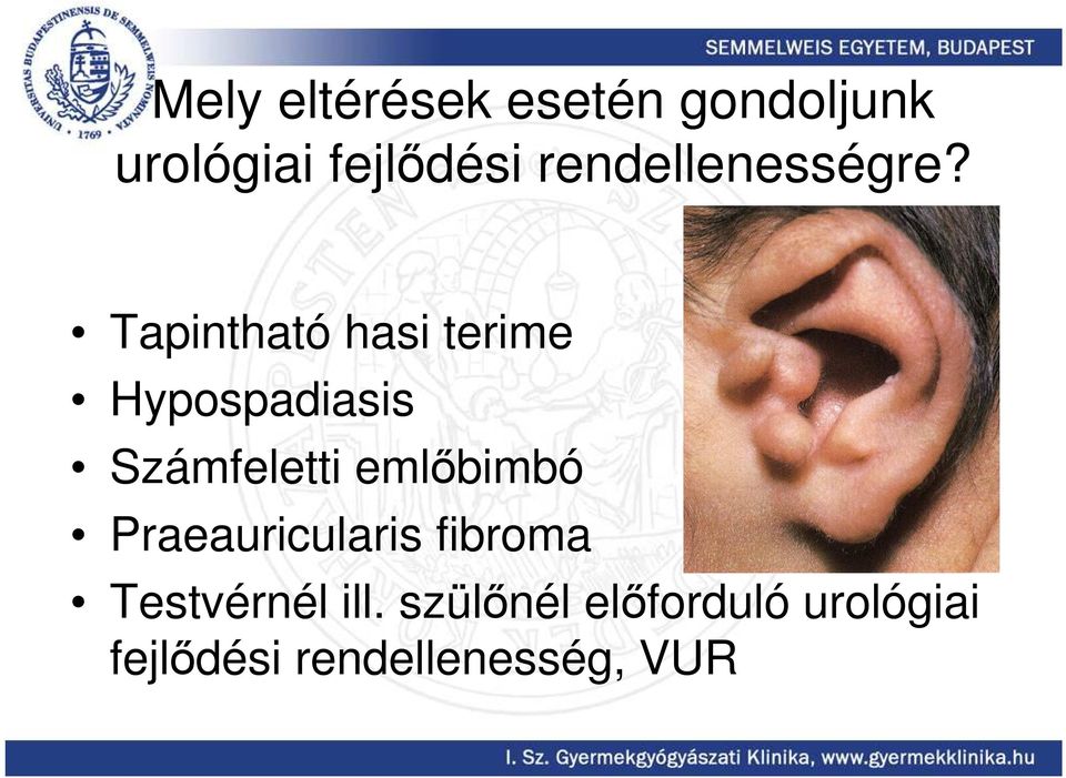 Tapintható hasi terime Hypospadiasis Számfeletti