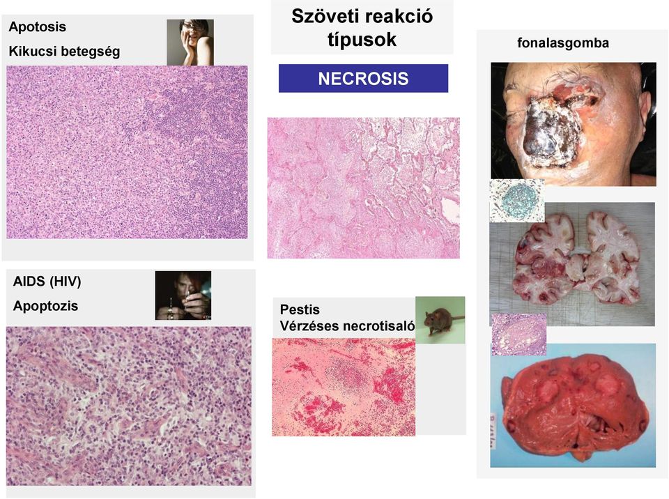 NECROSIS fonalasgomba AIDS