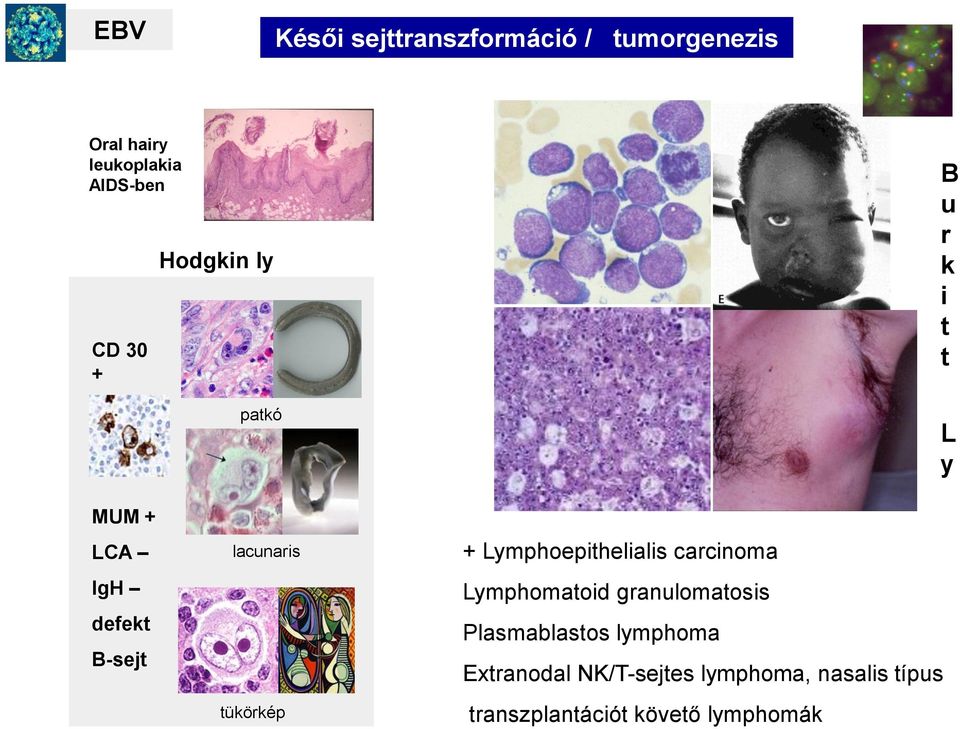 tükörkép + Lymphoepithelialis carcinoma Lymphomatoid granulomatosis Plasmablastos
