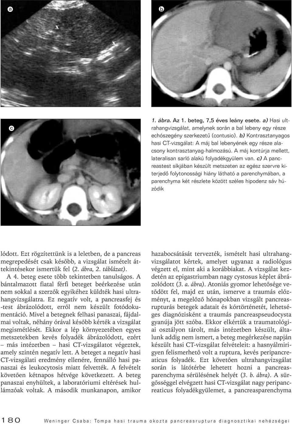 c) A pancreastest síkjában készült metszeten az egész szervre kiterjedô folytonossági hiány látható a parenchymában, a parenchyma két részlete között széles hipodenz sáv húzódik lódott.