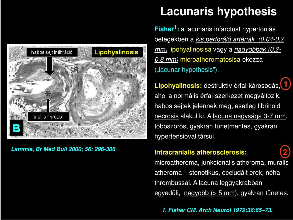 A lacuna nagysága 3-7 mm, többszörös, gyakran tünetmentes, gyakran hypertensioval társul.