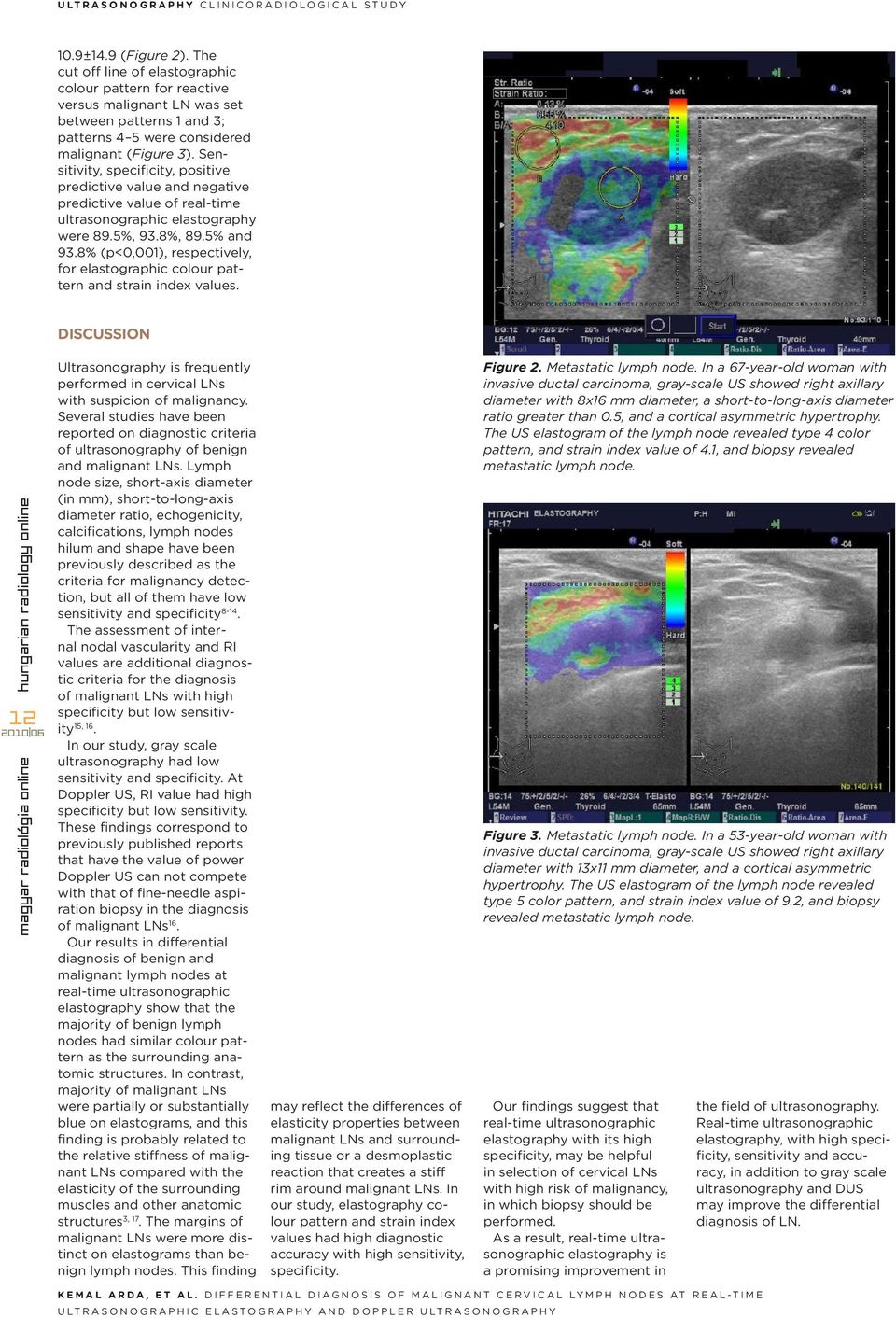 Sensitivity, specificity, positive predictive value and negative predictive value of real-time ultrasonographic elastography were 89.5%, 93.8%, 89.5% and 93.