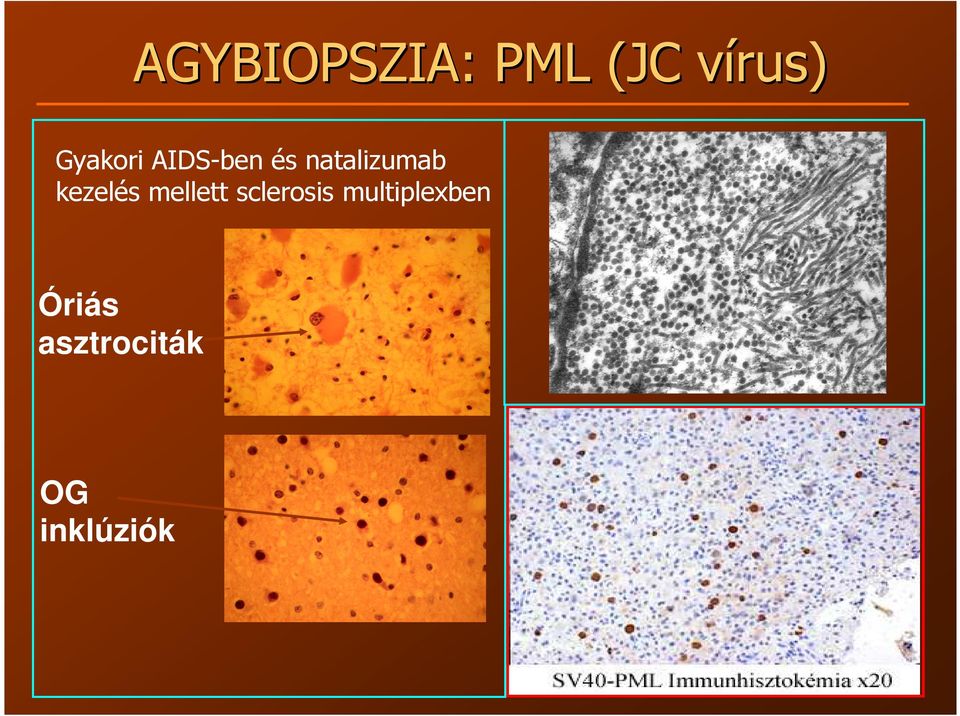 kezelés mellett sclerosis