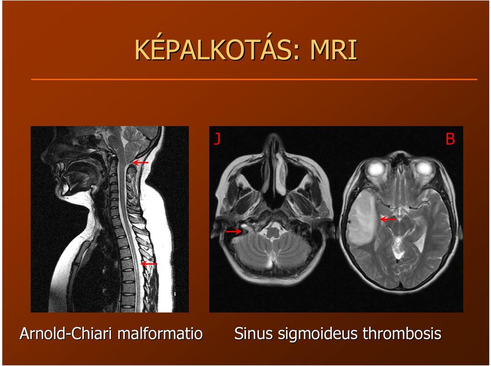 malformatio Sinus