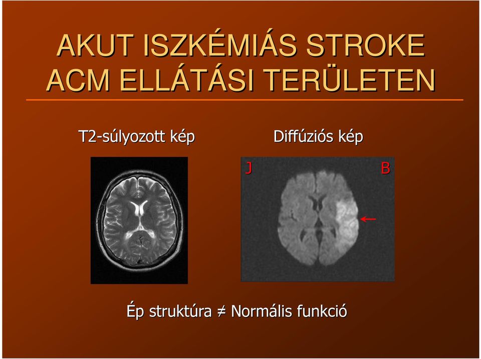 T2-súlyozott képk Diffúzi ziós