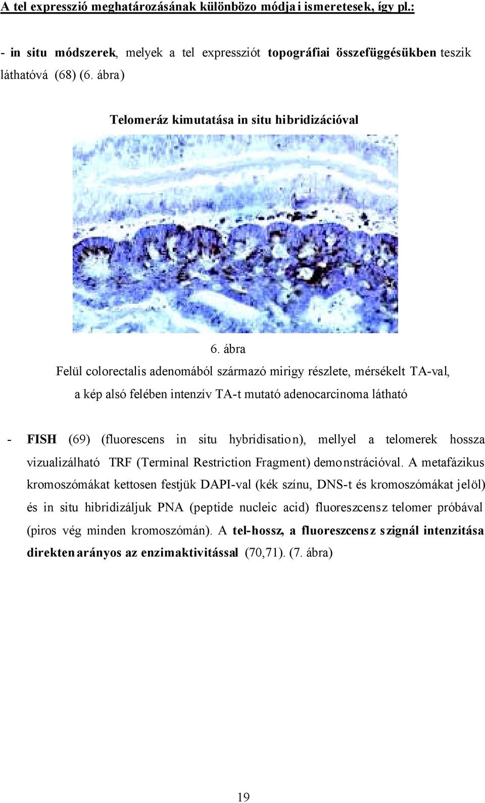 ábra Felül colorectalis adenomából származó mirigy részlete, mérsékelt TA-val, a kép alsó felében intenzív TA-t mutató adenocarcinoma látható - FISH (69) (fluorescens in situ hybridisation), mellyel