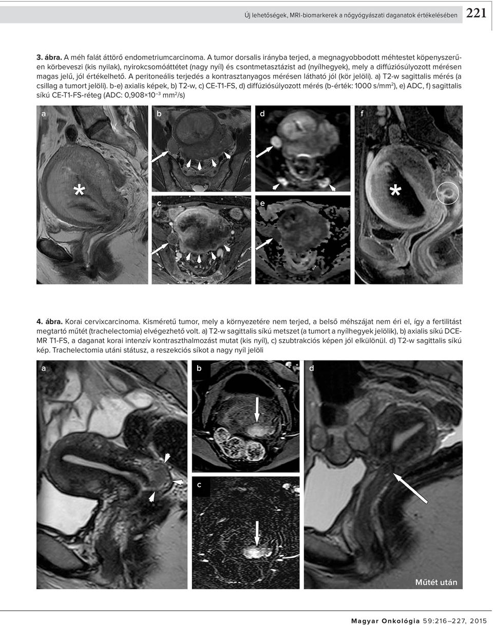 magas jelű, jól értékelhető. A peritoneális terjedés a kontrasztanyagos mérésen látható jól (kör jelöli). a) T2-w sagittalis mérés (a csillag a tumort jelöli).